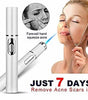 Blue Light Therapy Pen – Acne, Scar & Wrinkle Treatment Device